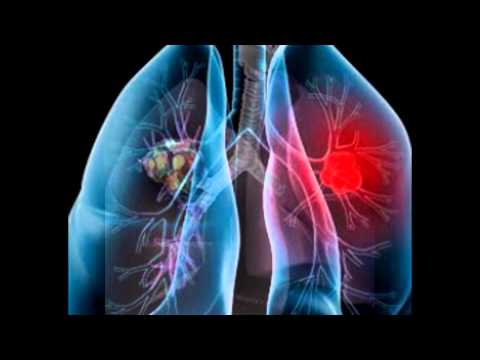 New york mesothelioma lawyer
