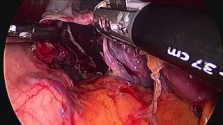 Laparoscopic unroofing of splenic cyst