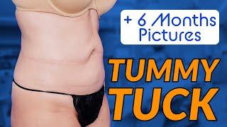 ummy Tuck Transformation: Muscle Repair, Skin Tightening \u0026 Belly Button Perfection! with Dr Dadvand