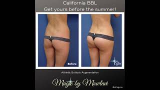 High Definition Athletic Buttock Augmentation