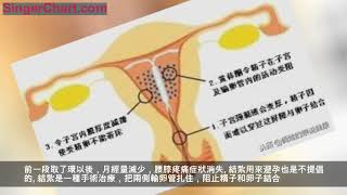 生完二胎到底結紮好還是上環好呢？聽專家說說