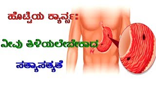 Kannada Lifestyle //symptoms of stomach cancer II ಹೊಟ್ಟೆಯ ಕ್ಯಾನ್ಸರ್: ನೀವು ತಿಳಿಯಲೇಬೇಕಾದ ಸತ್ಯಾಸತ್ಯತೆ