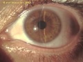 Hyperthermic, hypotony and sutures for LASIK flap repeated epithelial ingrowth and folds