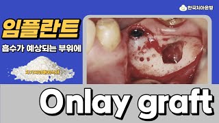 [한국치아은행] 93. 임플란트 심고 나서 얇아진 뼈! 흡수가 예상된다면, 뼈로 치환되는! 자가치아뼈이식재를 사용해보세요!_Implant Onlay graft편