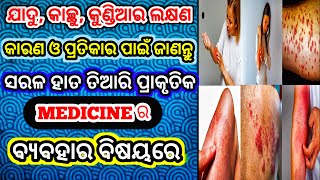 ଯାଦୁ, କାଛୁ, କୁଣ୍ଡିଆର ଘରୋଇ ଉପଚାର | Jadu kachu kundiya Medicine | Eczema Infection | Skin Disease