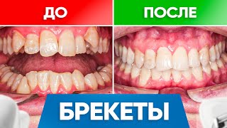 Брекеты До и После – реальные примеры работ со взрослыми пациентами