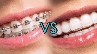 Aligners vs fixed orthodontics in Malayalam 4K