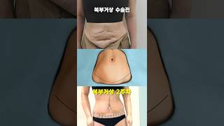 #복부거상 처진살 .. 다시는 못볼줄 알았던 잘록한 허리 꿈만 같아요😭 #복부거상술