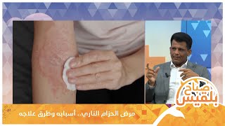 مرض الحزام الناري.. أسبابه وطرق علاجه مع الطبيب كمال الشرعبي