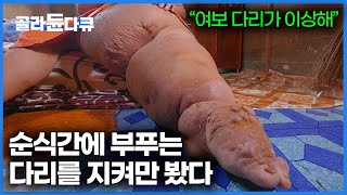 평소처럼 숲에 다녀온 아내의 다리가 이상하다│속수무책으로 한 쪽 다리가 4배 부푼 이유│다큐프라임 기생│#골라듄다큐