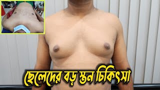 GYNECOMASTIA - Man Boobs / ছেলেদের বড় স্তন ছোট করার  চিকিৎসা