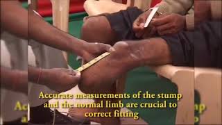 Making of Jaipur Foot : Free Jaipur Foot : Jaipur Artificial Foot Below Knee  Walks for First Time