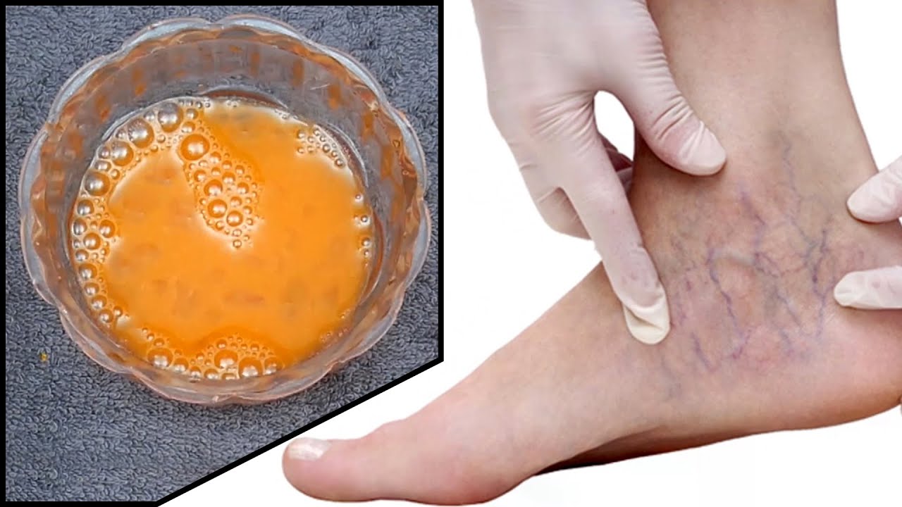 Cure Varicose Veins With This NATURAL REMEDIES | Health And Safety ...