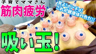 【吸い玉】子育てママさんに吸い玉！自転車での筋肉痛が吸い玉で一発解消！見よ！院長！これが健康体の吸い玉跡だ！