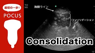 consolidation コンソリデーション【POCUS・肺超音波】