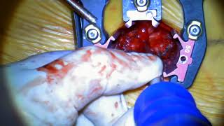 Surgitel Video Example