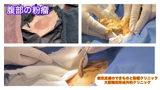 腹部の粉瘤　ブログでも粉瘤について詳しく解説してます。東京皮膚のデキモノと粉瘤クリニック　ふるばやし形成外科　東京新宿院　大阪梅田形成外科クリニック