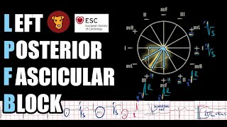 LEFT POSTERIOR FASCICULAR BLOCK (left posterior hemiblock) ECG CRITERIA formation, etiology