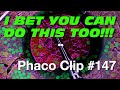 Phaco Clip #147 - I Bet You Can Do This Too!