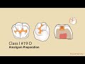 Class I Amalgam Preparation | My Dental Key