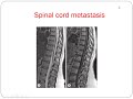 imaging of spinal tumors