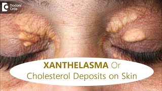 FATTY DEPOSITS of CHOLESTEROL around EYES | How to get rid of it?-Dr.Rajdeep Mysore|Doctors' Circle