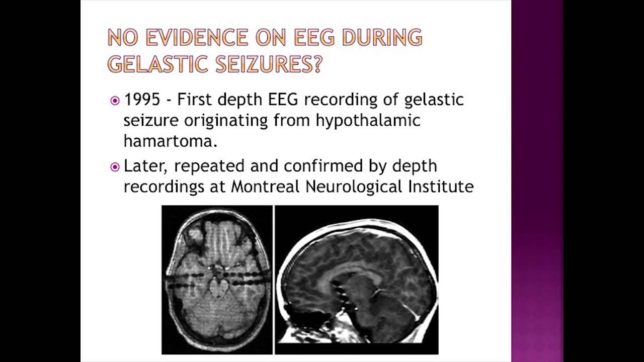 Neurological Assessment Hypothalamic Hamartomas Dr Michael Quach