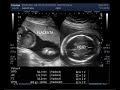 Hydrops fetalis, with Fetal Soft tissue edema,  Ascites, and Pleural effusion.