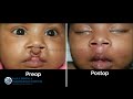 bilateral cleft lip surgery