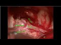 Clipping of anterior communicating artery aneurysm- Dr.Vijaymahantesh Pujari