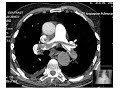 Management of VTE (Dr. Youssef Amin)