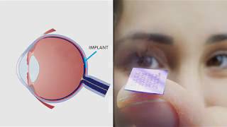 Restoring Vision Using Fractal Bionic Eyes - Dr. Richard Taylor