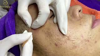 Loan Nguyen Acne Treatment 00144