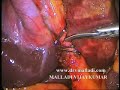 Laparoscopic Cholecystectomy   Gallstone Pancreatitis