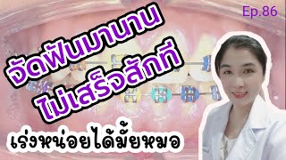 จัดฟันนาน ไม่เสร็จสักที เร่งหน่อยได้ไหมหมอ @หมอฟันลงจอ Ep.86