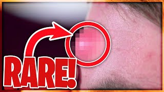 10 of The most *RARE* cases on Dr. Pimple Popper!