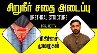 சிறுநீர் அடைப்பு அறுவை சிகிச்சை தேவையா? URETHRAL STRICTURE in Tamil #drsj