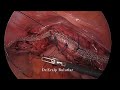 Laparoscopic Lateral Suspension