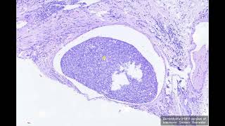 Mammary carcinoma - signs of malignancy - angiomatosis carcinomatosa // dog // Vanessa Herder