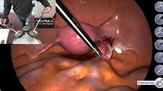 Salpingectomy Simulation with Hand Coordination on SimBall Station