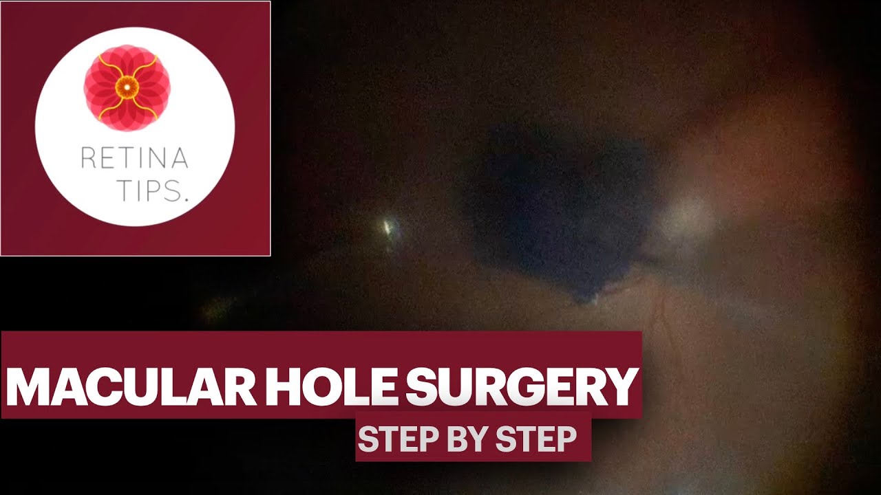 Macular Hole Surgery Step By Step - YouTube