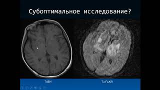 Дроздов А.А. «Дифференциальная диагностика ВИЧ индуцированных энцефалитов»