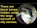 There are black lumps hidden under the large amount of oily earwax.|ear wax removal | ASMR |