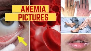 Anemia Pictures - Early Signs Symptoms Photos Images and Pictures of Anemia