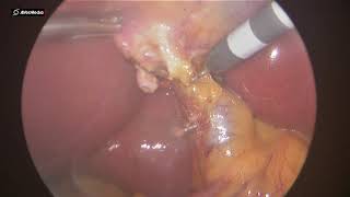 21072020 Laparoscopic Cholecystectomy for Gallbladder stones 1249