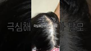 어 나 20대 여자 대학생인데 탈모 극복했다 두피문신 후기 아르켜줄게...#내돈내산