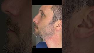 Stubble Beard 2mm VS 1mm