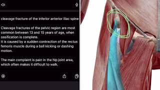 「スポーツ障害」下前腸骨棘裂離骨折 cleavage fracture of the inferior anterior iliac spine