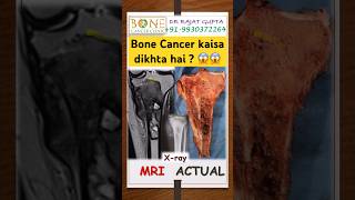 😱Bone Cancer andar se kaisa dikhta hai ?Osteosarcoma knee- Dr Rajat Gupta @bonecancerclinic