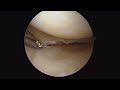 knee arthroscopy partial medial menisectomy for a tear of the meniscus